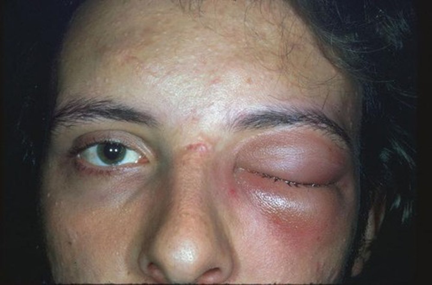 <p><u>Etio</u>:<strong> infection of the posterior orbit</strong>, S. pneumo, H. influenzae, M. caratthalis, S. aureus</p><p><span><u>Risk Factors</u></span>: rhinosinusitis, dacrocystitis, teeth infection, middle ear infection</p><p><span><u>S&amp;S</u></span>: unilateral <strong>proptosis</strong>, swelling, <strong>pain</strong> with eye movement, <strong>redness</strong>, edema, diplopia, vision loss</p><p><span><u>Diagnostic Studies</u></span>: <strong>contrast enhanced CT</strong></p><p><span><u>Complications</u></span>: abscess, loss of vision, <strong>death</strong> if untreated</p><p><span><u>Tx</u></span>: <strong>IV Vancomycin</strong> w/ IV ceftriaxone or IV cipro, then discharged on <strong>clindamycin</strong> 300 mg PO TID or <strong>Bactrim</strong> DS PO BID plus <strong>Augmentin</strong> PO BID 2-3 weeks, admit to hospital, emergent referral to ophthot, </p>