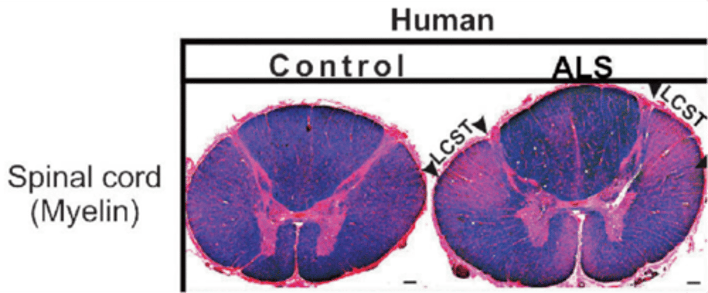 <p>MND/ALS is characterised by what?</p>