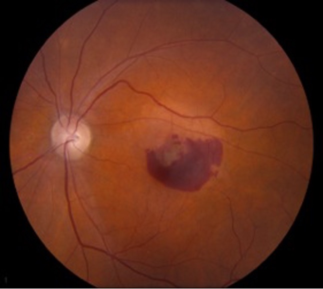 <p>Fundus photography would typically show choroidal neovascularisation and possible haemorrhages at the macula. </p>