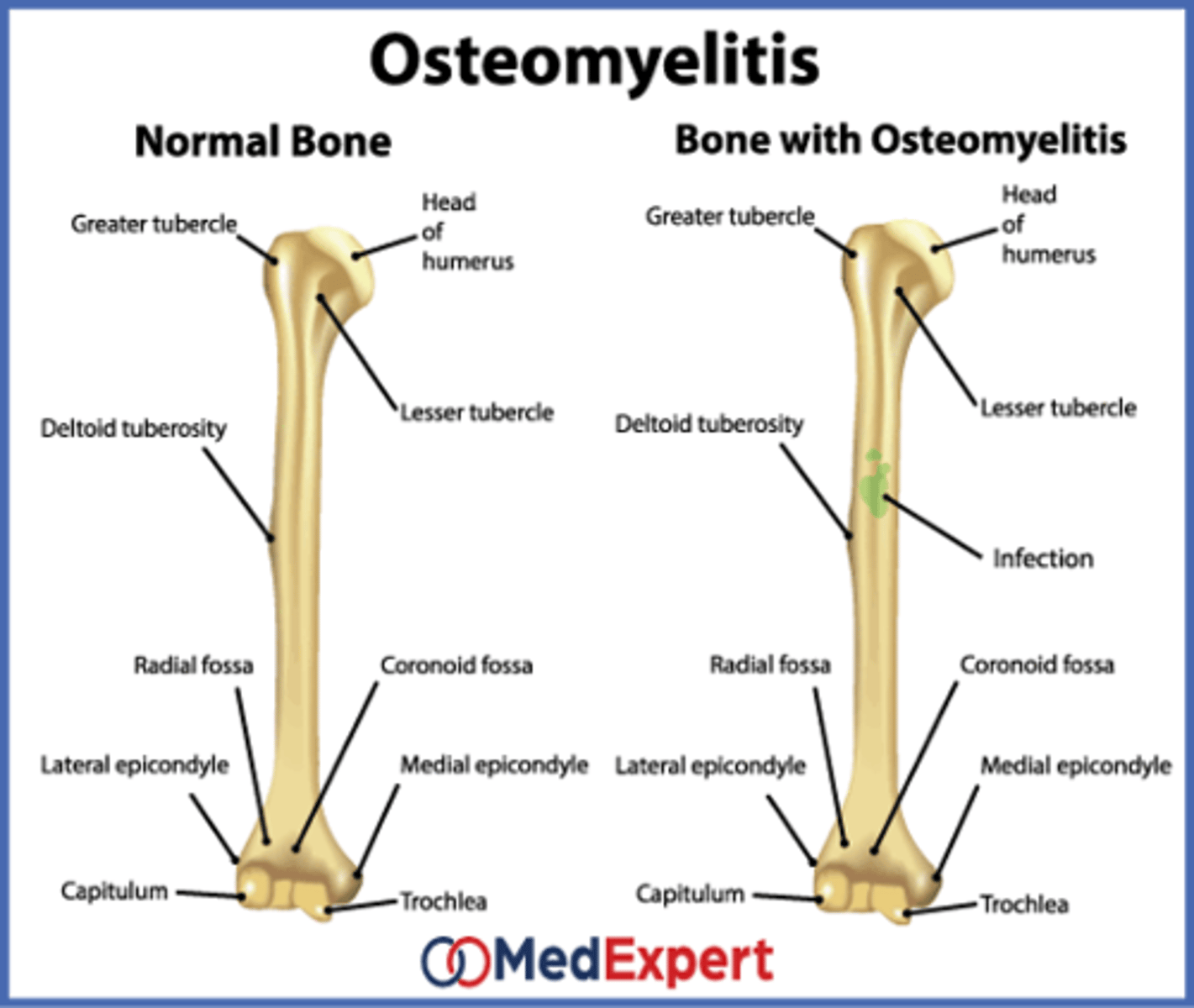 <p>Bacterial infection in the bone that leads to bone destruction. It can be an acute and/or chronic condition</p>