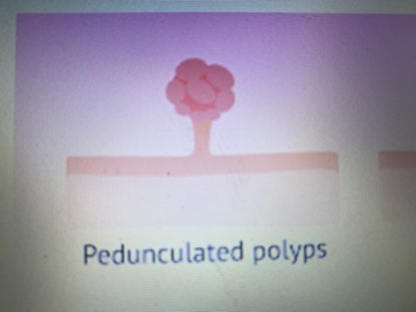 <p>Pedunculated base is opposite and resembles a stem or stalk.</p>