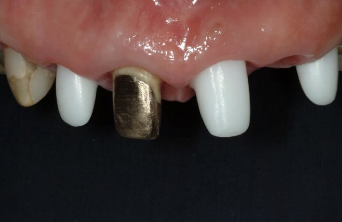 <p>if the anterior tooth has a gold foil on the tooth substrate, what material would you use for a full coverage all ceramic crown </p>