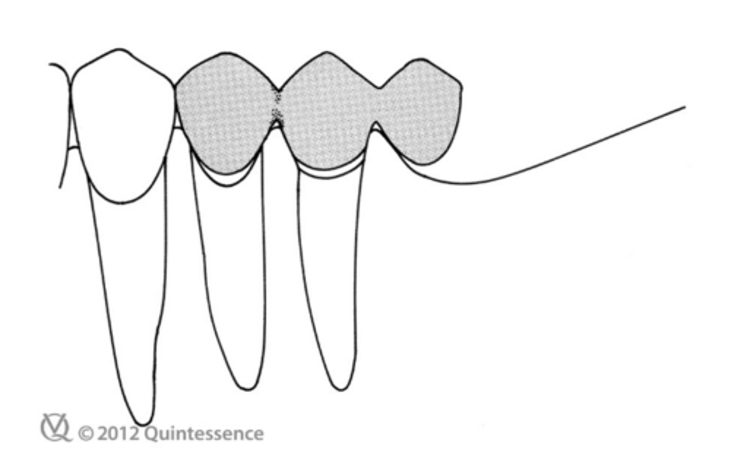 <p>This shows a cantilever fixed partial denture replacing a mandibular first molar, using both premolars as abutment teeth. How does this cantilever minimize stress on the abutments?</p>