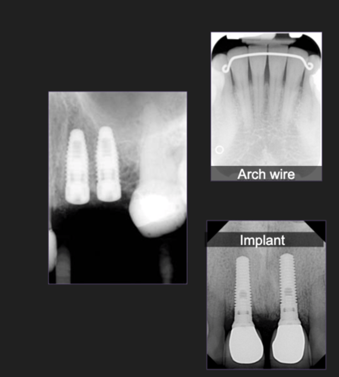 <p>- Orthodontic bands and arch wires</p><p>- Oral surgery implants</p><p>- Jewelry</p><p>- Eyeglasses</p><p>- Dentures, or RPD</p>