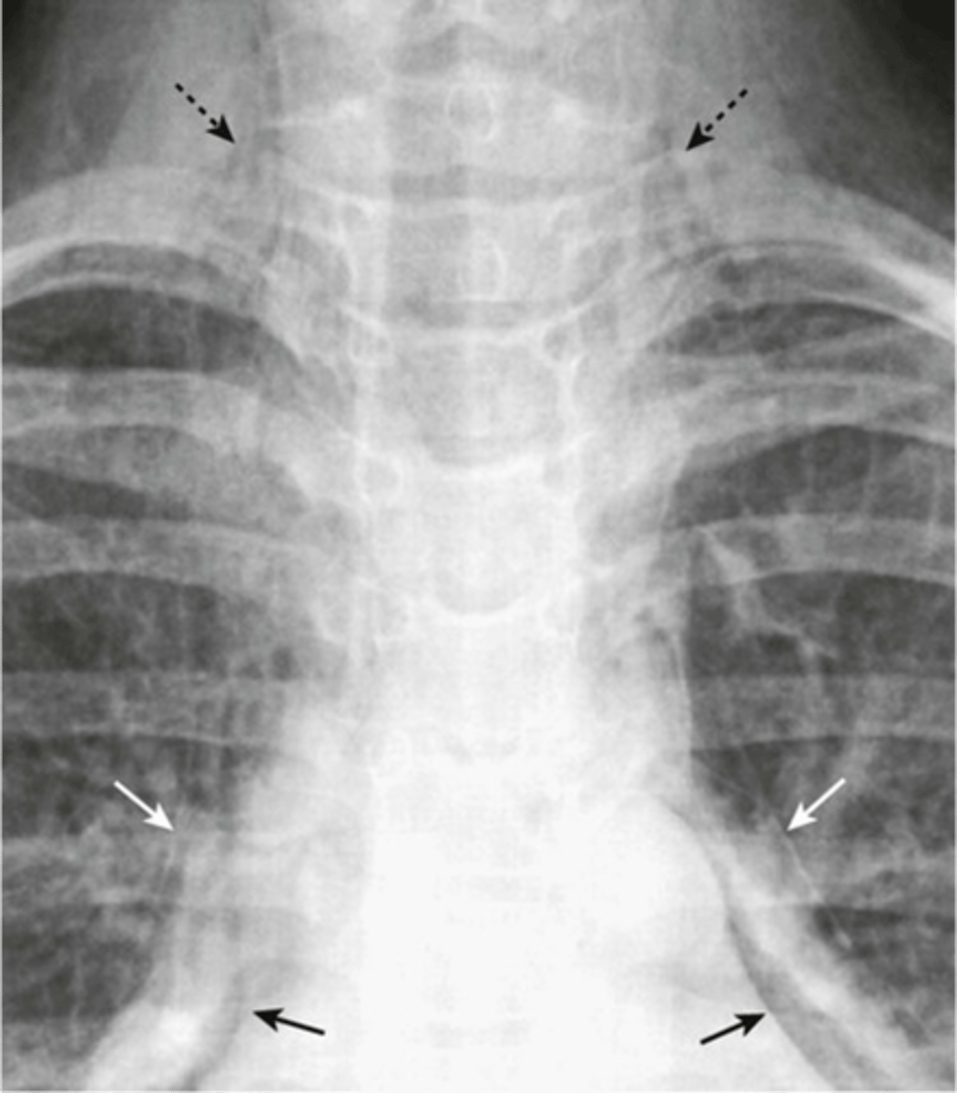 <p>-stringy densities (air in neck)</p><p>-air around the heart</p>