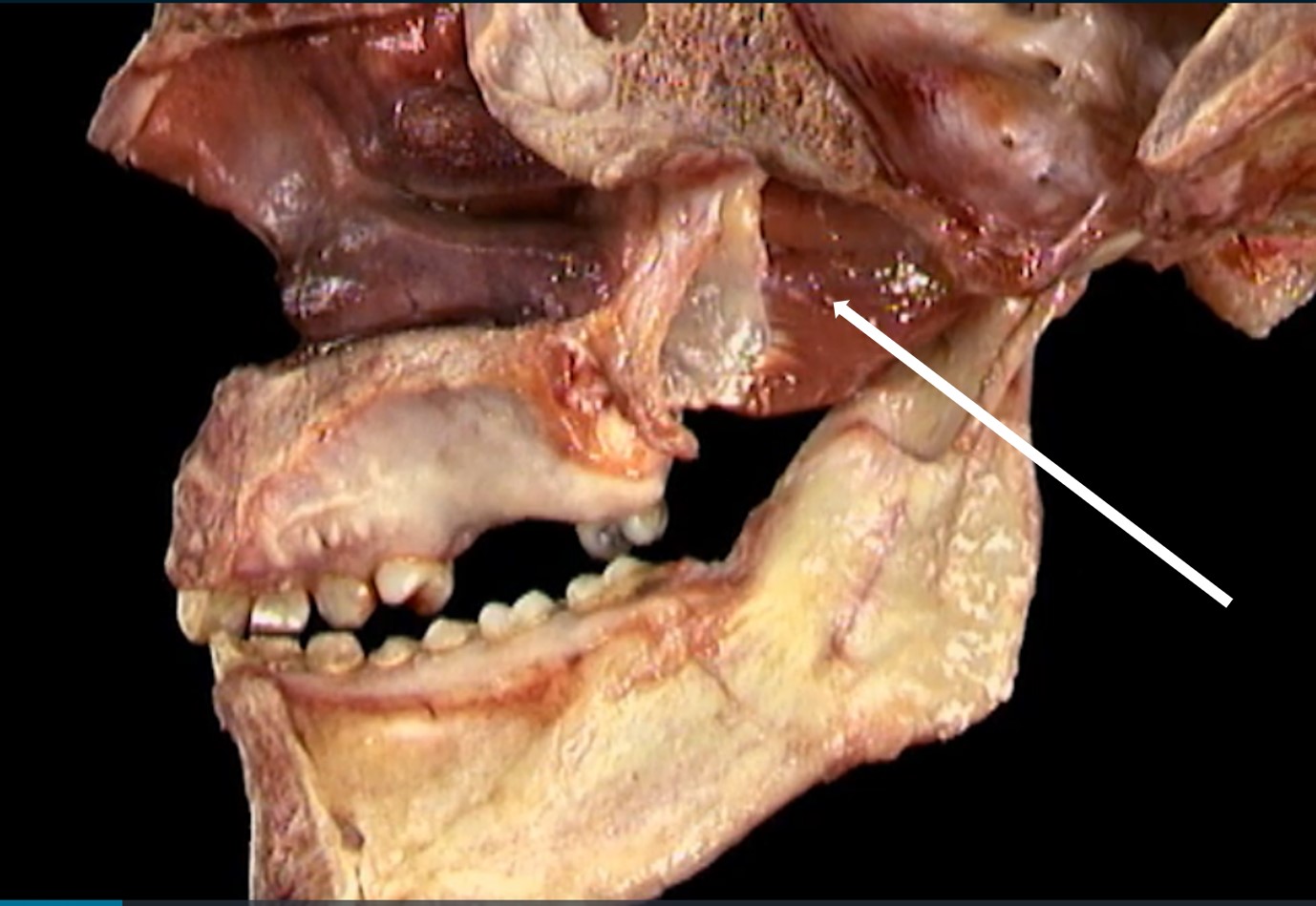 <p>spier t.h.v. rechtse zijde van mandibula</p>