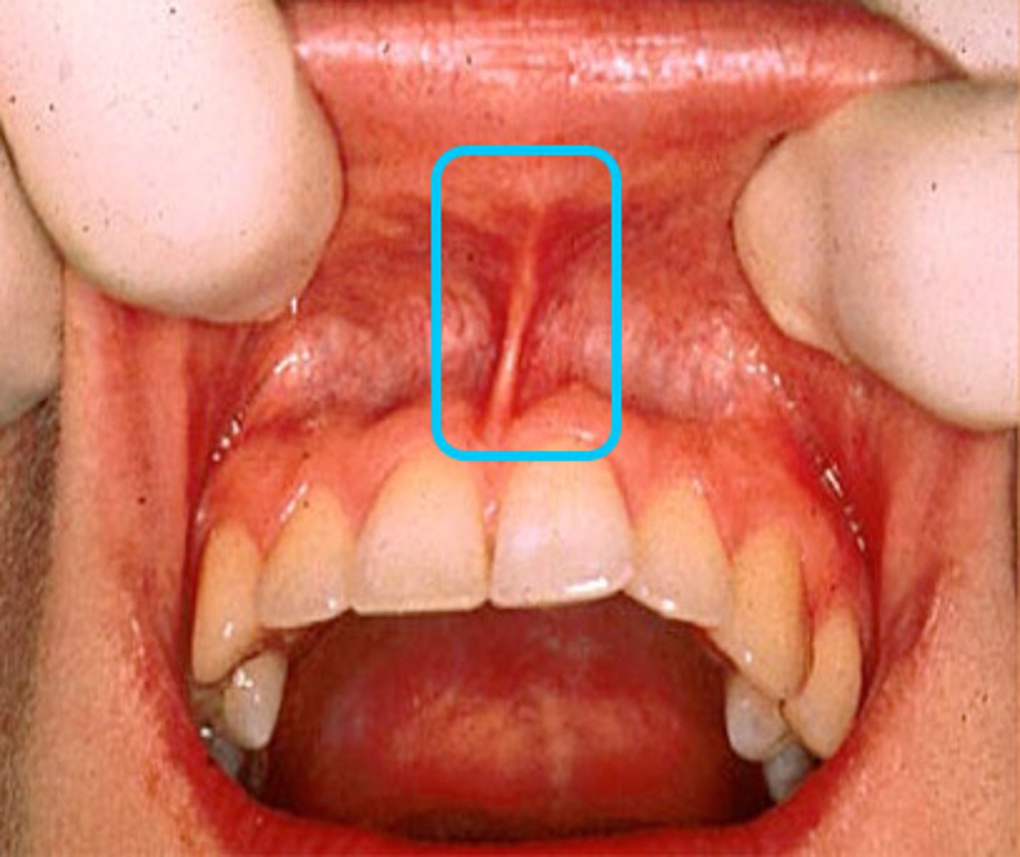 <p>A fold of connective tissue attached to the upper alveolar mucosa. It is more pronounced than the lower frenum.</p><p>*fun fact: if the maxillary frenum is very firm or low, it may cause the central incisors to be pushed aside as it cannot penetrate it. There will be a gap between teeth (classic tooth gap look)</p><p>*if the mand. frenum extends too close to the gingiva, it can contribute to gingival recession as it pulls down on the gingiva.</p>