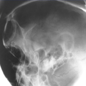 <p>What is this x-ray demonstrating?</p>