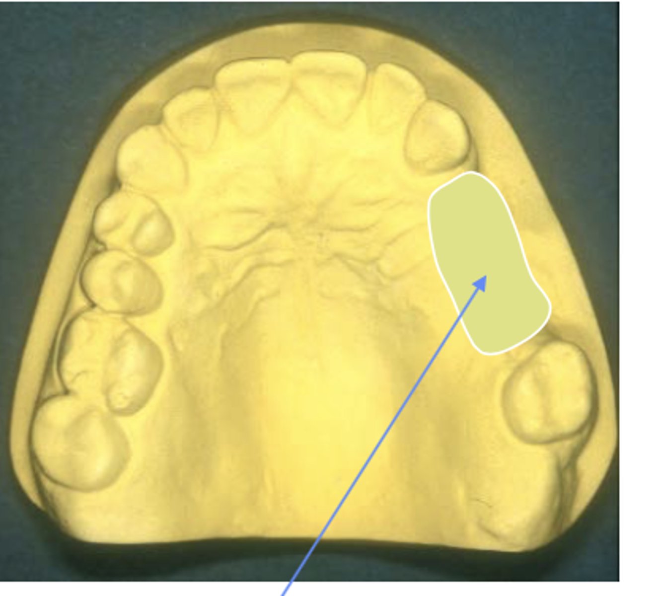 <p>Kennedy classification:</p><p>- A unilateral edentulous area with natural teeth both anterior and posterior to the area</p>