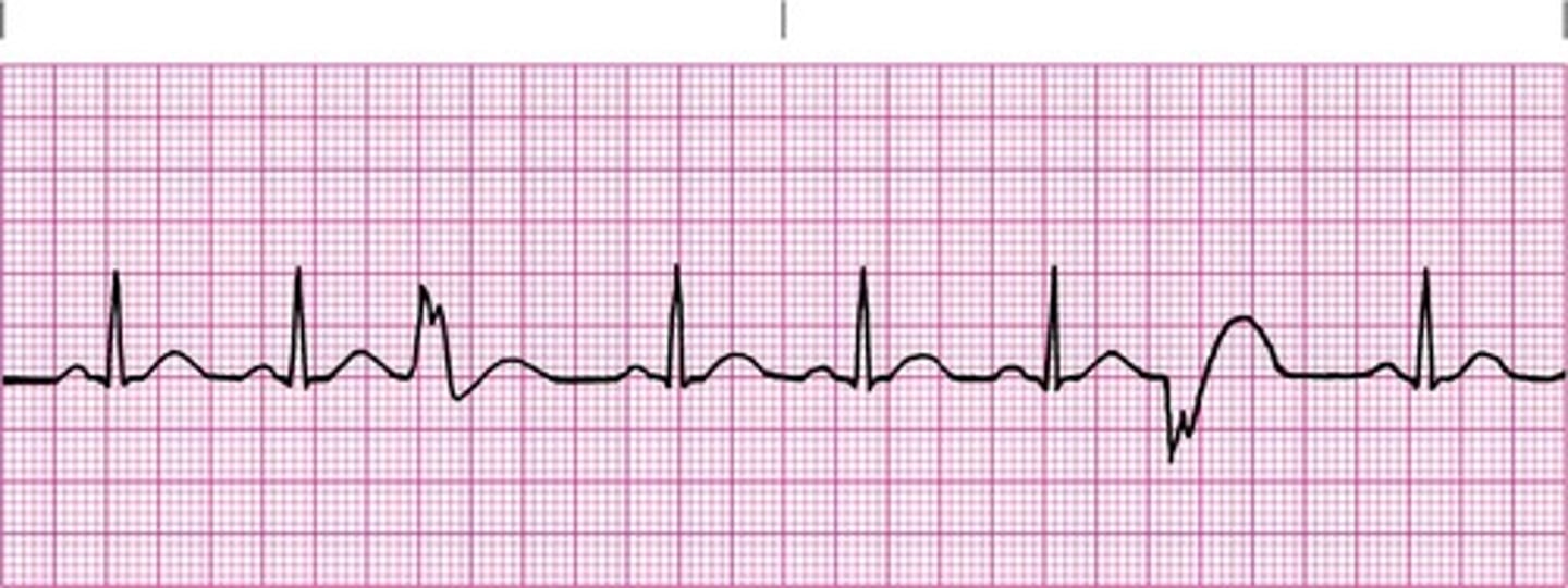 <p>What does this EKG strip show</p>