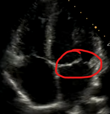 <p>What valve is circled</p>