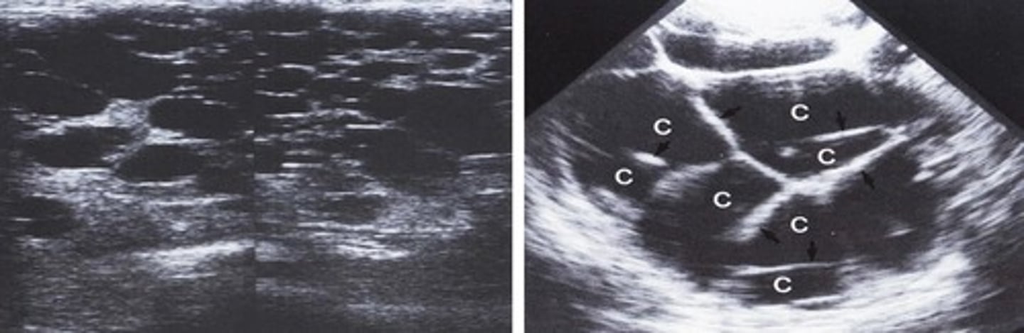 <p>Genetic</p><p>Biliary duct anomalies</p><p>Will have polycystic kidney disease and pancreatic cysts at the same time</p>