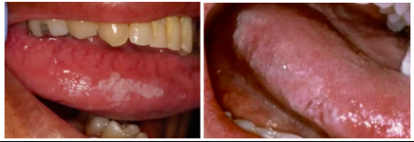 <p><span style="background-color: transparent; font-family: &quot;Times New Roman&quot;, serif;">*<strong>White leukoplakia, non-removable patch</strong> (differential dx: EBV, OHL, dysplasia)&nbsp;</span></p><p><span style="background-color: transparent; font-family: &quot;Times New Roman&quot;, serif;">-<strong>Lateral tongue</strong></span></p>