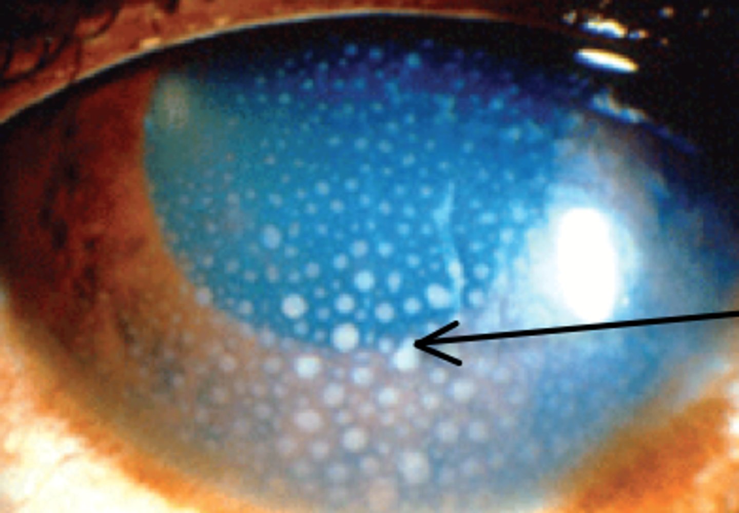 <p>What Uvea condition(s) would also show granulmoas in the conjunctiva?</p>