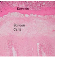 <p><span style="background-color: transparent; font-family: &quot;Times New Roman&quot;, serif;">*Histology shows <strong>balloon cells</strong></span><br><span style="background-color: transparent; font-family: &quot;Times New Roman&quot;, serif;">*Test balloon cells – <strong>EBER</strong> (in-situ hybridization for EBV)</span></p>