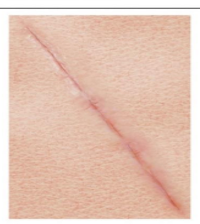 <p>Fibrous tissue that replaces normal skin after injury or surgery, often pale or white in color</p>