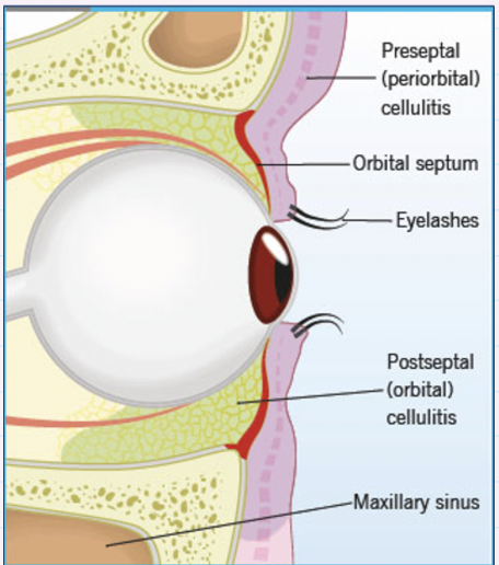 <ul><li><p><strong><mark data-color="#fffd82" style="background-color: rgb(255, 253, 130); color: inherit;">Bacterial INFECTION</mark></strong> (Staphylococcus, Haemophilus)</p></li></ul><p></p><ul><li><p>Periorbital or orbital tissue</p></li></ul><p></p><ul><li><p>most commonly <strong><10 years old</strong></p></li></ul><p></p><ul><li><p>severity varies from minor to life threatening</p></li></ul><p></p>