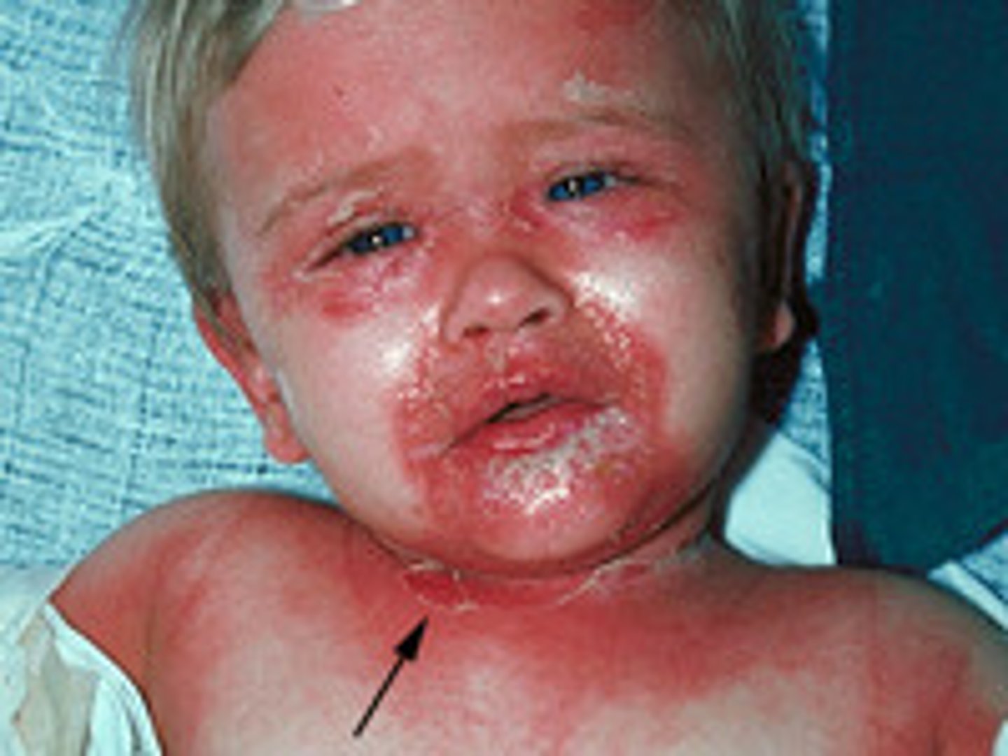 <p>- starts with generalised patches of erythema on the skin (looks thin and wrinkled)</p><p>- then forms bullae which burst and end up looking like a scald/burn</p>