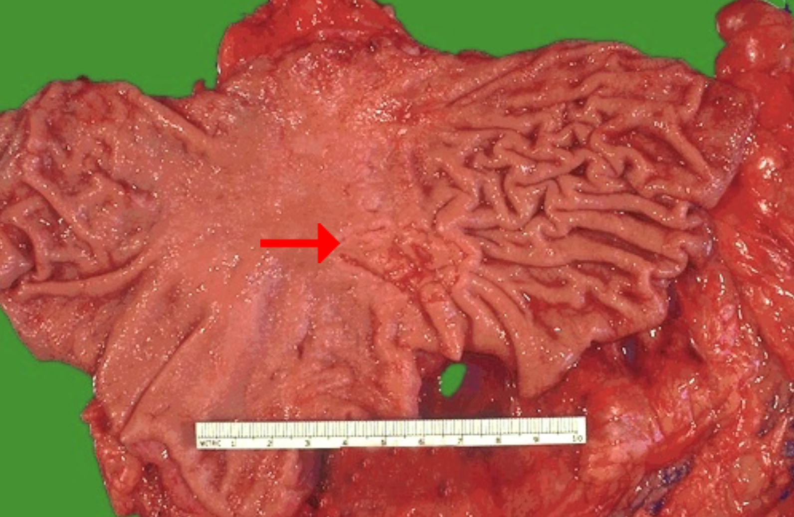 <ol><li><p>Ulcer</p></li><li><p>Biopsy</p></li></ol><p></p><p>All gastric ulcers and all gastric masses must undergo biopsy because it is impossible to determine malignancy from their gross appearance. In contrast, virtually all duodenal peptic ulcers are benign.</p><p></p>