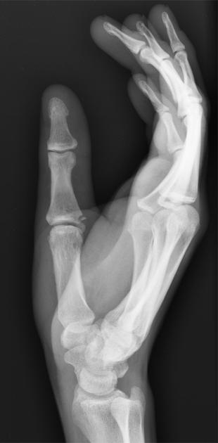 <p>Describe the abnormality demonstrated. </p>