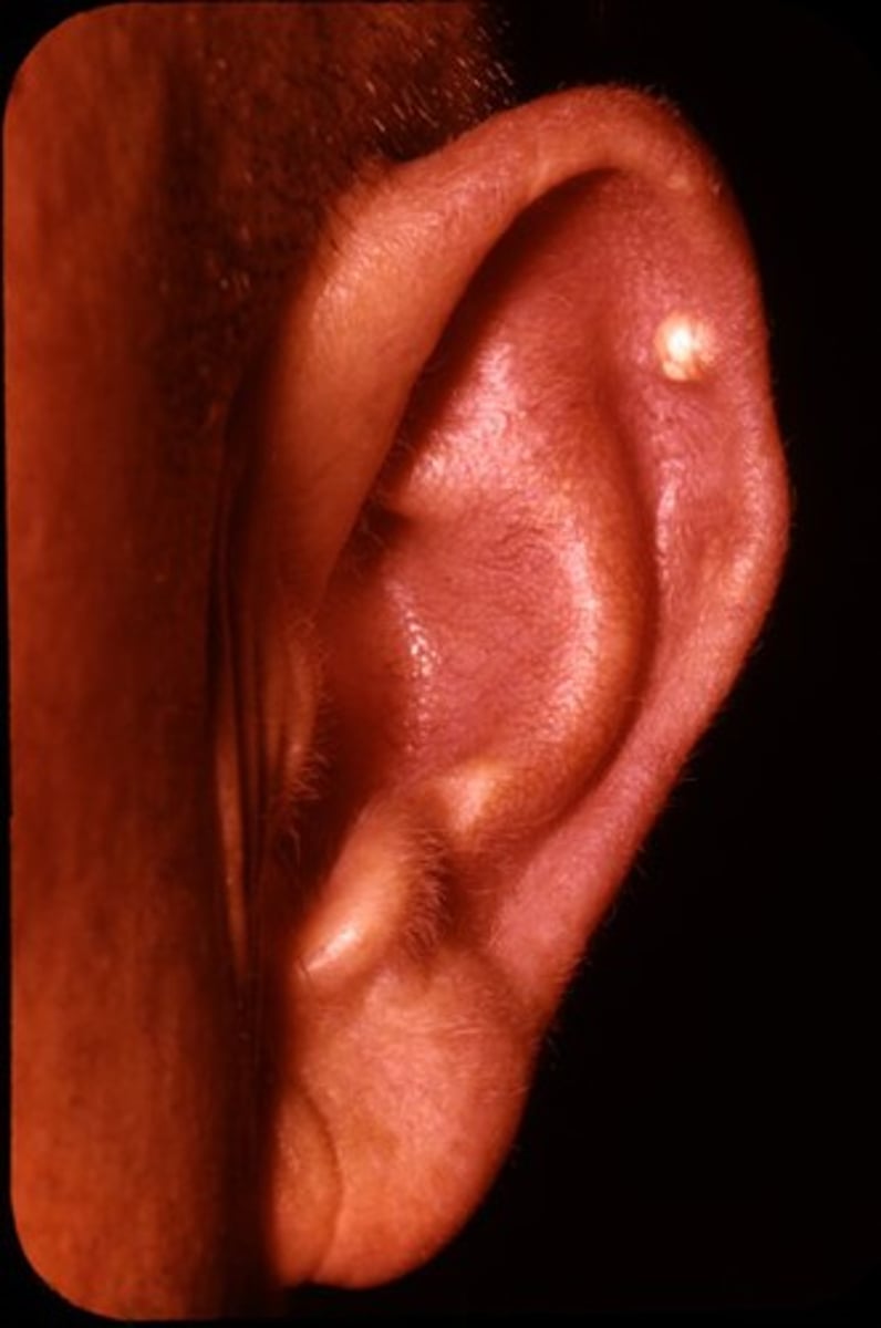 <p>a deposit of crystalline uric acid and other substances at the surface of joints or in skin or cartilage, typically as a feature of gout) formation often on external ear, olecranon bursa or achilles tendon</p>
