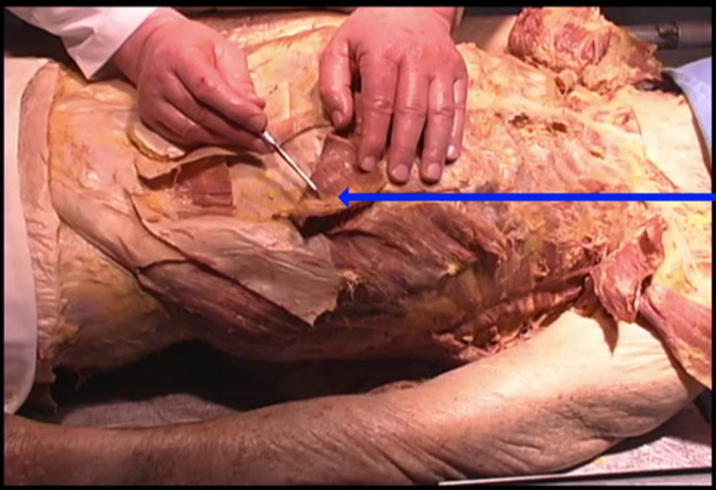<p>What is the name of the artery being shown here by the blue arrow?</p><p>superior intercostal artery</p><p>inferior intercostal artery</p><p>superior epigastric artery</p><p>inferior epigastric artery</p>