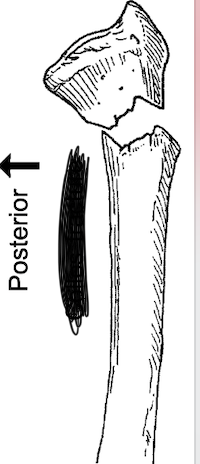 <p>What type of fracture is this?</p>