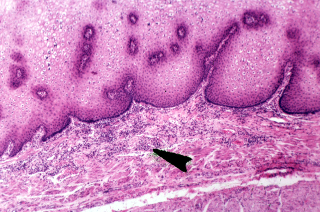 <p><strong>Diffuse lymphatics</strong></p><p><em>A concentration of purple dots observed</em></p>