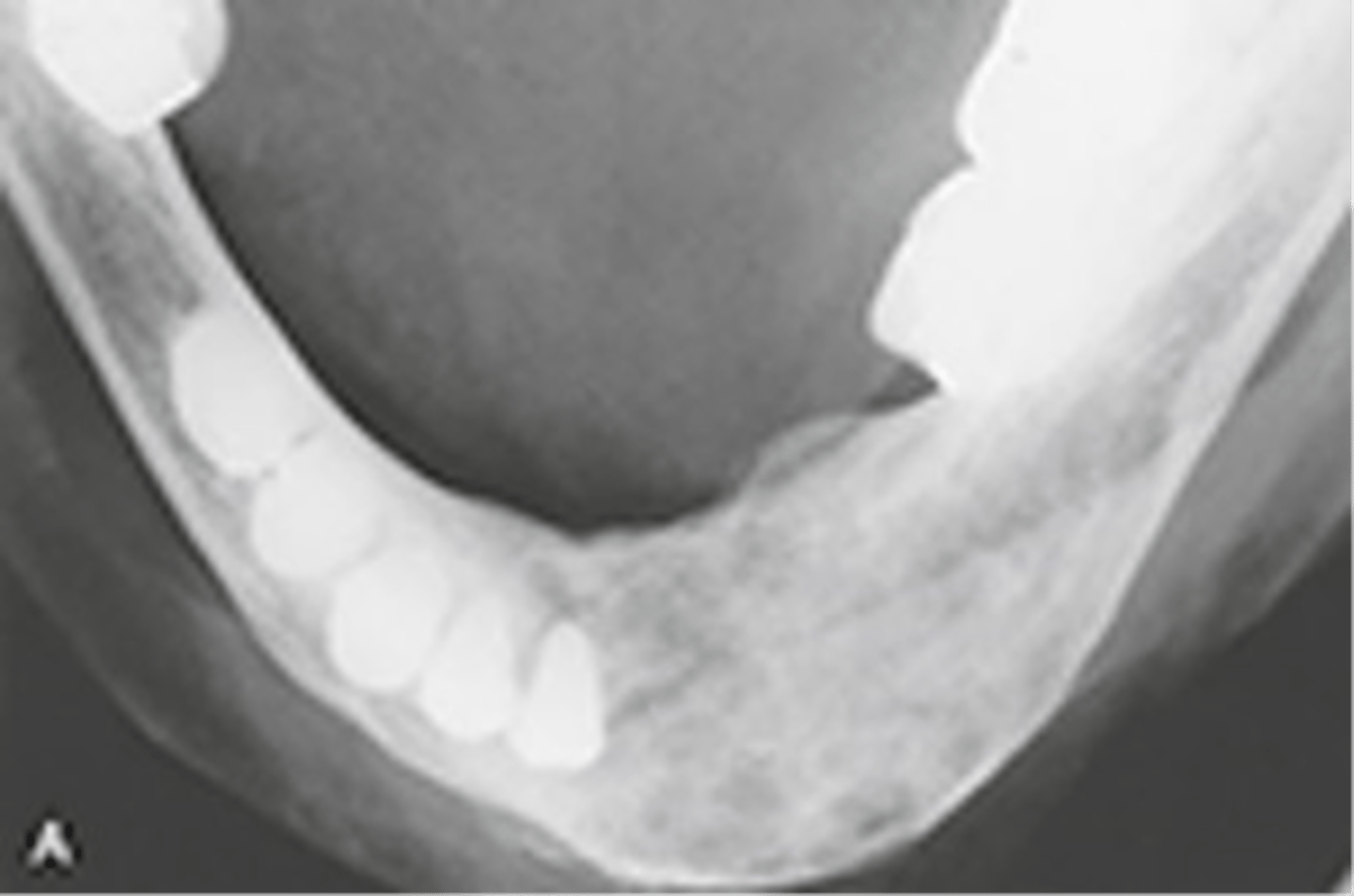 <p>seen radiographically in a patient with hyperparathyroidism</p><p>-radiolucencies also called brown tumors</p>
