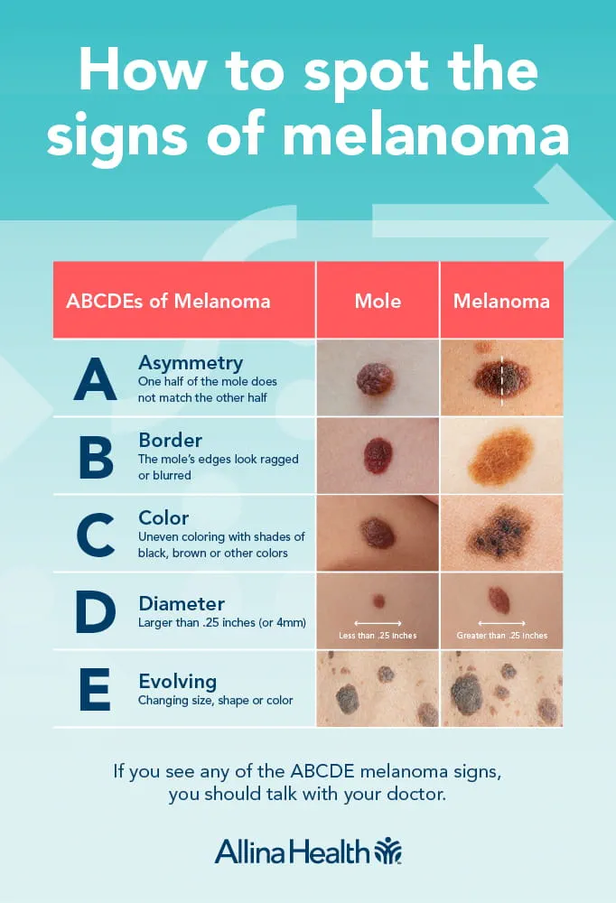<p>PP: malignancy of melanocytes in skin<br>half-develop from pre-existing nevi in normal-appearing skin</p><p>RF: atypical nevi<br>fair skin<br>family hx<br>sunburns (5+/1 blistering→2x risk)</p><p>E: women<br>25-29 y/o</p><p>CM:</p><p><u>lentigo maligna</u></p><ul><li><p>older patients</p></li><li><p>heavily sun-damaged skin</p></li><li><p>tan macule→spreads+darkens</p></li><li><p>5+ years→invasive</p></li></ul><p><u>superficial spreading</u></p><ul><li><p>most common</p></li><li><p>any form of skin</p></li><li><p>upper back</p></li><li><p>multicolored</p></li></ul><p><u>acral-lentiginous</u></p><ul><li><p>dark skin+asian</p></li><li><p>periungual hyperpigmentation (dark pigment under nails)</p></li><li><p>hutchinson’s sign (pigmented streak+black color on proximal nail fold)</p></li></ul><p><u>nodular</u></p><ul><li><p>smooth+dome shaped tumors</p></li><li><p>sun-exposed areas</p></li><li><p>bleeding→late sign</p></li></ul><p><u>amelanotic:</u></p><ul><li><p>non-pigmented</p></li><li><p>pink/erythematous/flesh-colored</p></li></ul><p>DX:<br>ABCDE<br>asymmetry<br>border irregularity<br>color variation<br>diameter over 6mm<br>evolution (metastasis)</p><p><u>1mm+ thickness→sentinel lymph biopsy</u></p><p>TX:<br><u>early (5-20mm)</u>→surgical excision</p><p><u>metastatic</u><br>NP: radiation<br>chemotherapy</p><p>MX: ipilimunab+nivolumab</p><p>P: deadliest skin cancer<br>deeper→worse prognosis<br>metastatic→6-9 months<br>metastatic 5 year survival rate→under 20%</p>