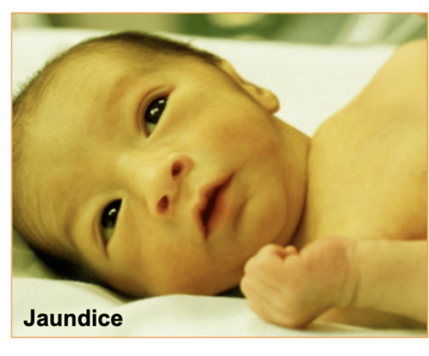<p>yellowish discoloration of skin and sclera due to excess of bilirubin in blood</p><p>Some causes- Cancer, hepatitis,compromised liver function.</p><p>(common in babies when they're first born)</p>