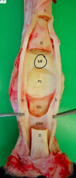 <p>(PS) → Surface de glissement pour le TBS formée par Os. sesamoidea prox. et Lig. palmare </p>