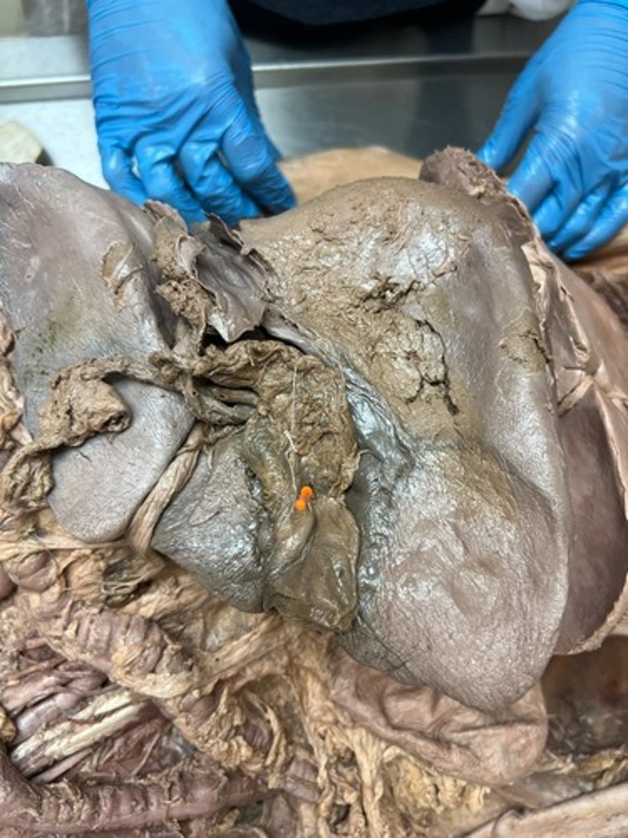 <p>body of gallbladder</p>