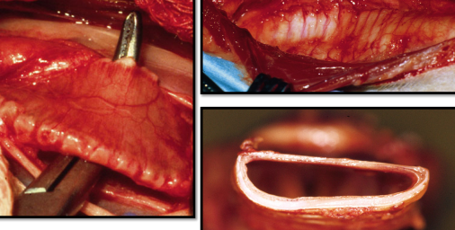 <p><span>Collapsing trachea</span></p>