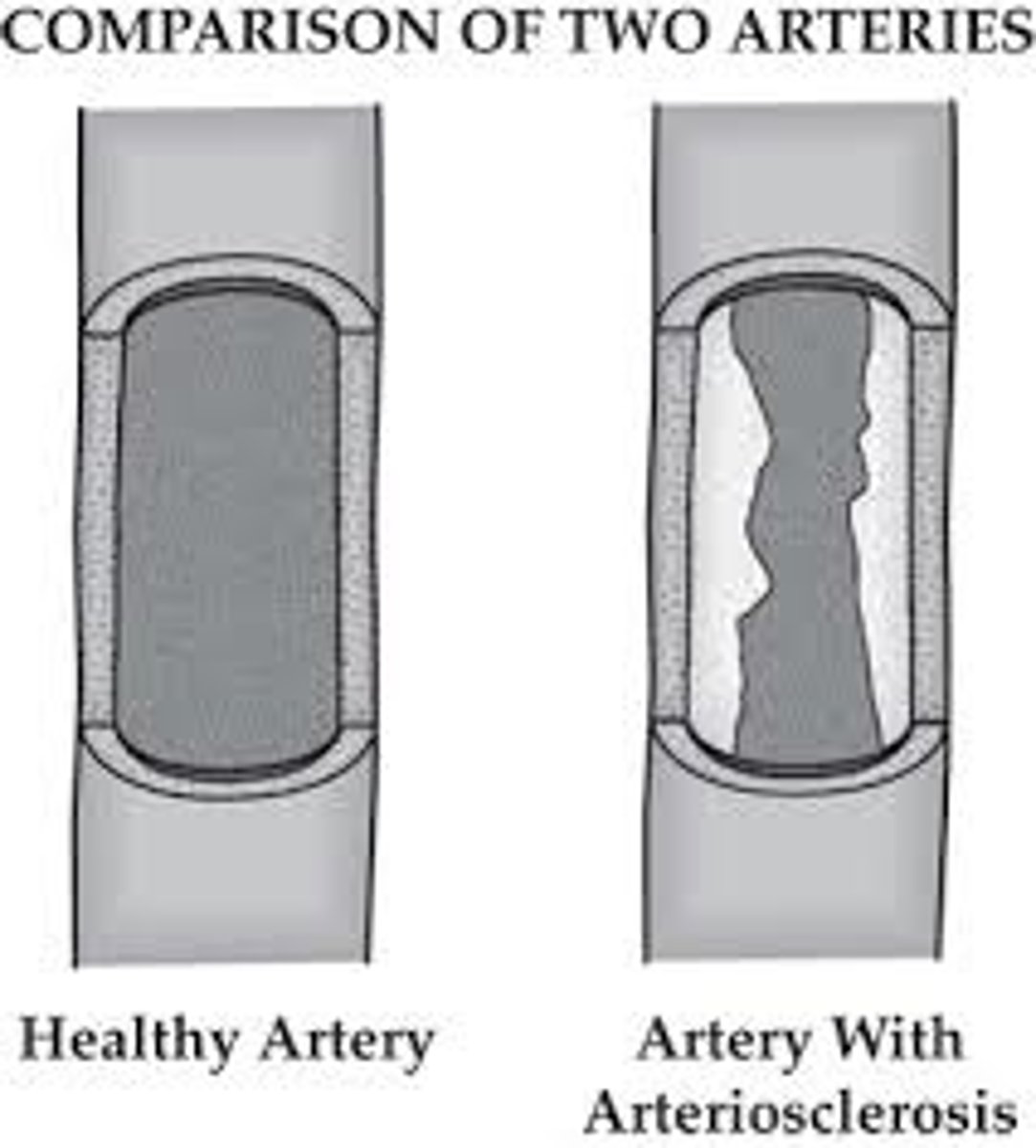 <p>arterioesclerosis</p>