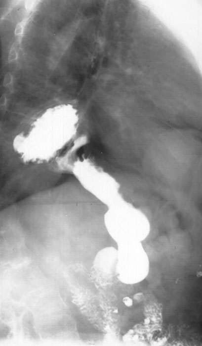 <p>How do you differentiate the esophagus from the stomach on a barium study?</p>