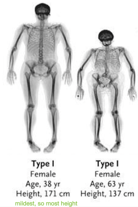 <p>In <em><u>type I OI</u></em>, how much bone fragility is there? how many fractures?</p><ul><li><p>how much bone malformation?</p></li><li><p>when do most fractures occur?</p></li><li><p>what is the birth height/weight? </p></li><li><p>are the muscles strong/weak? </p></li><li><p>joint laxity or hypomobility?</p></li><li><p>what feet position?</p></li><li><p>dislocations and what?</p></li><li><p>what is life expectancy?</p></li><li><p>associated w/ what color sclera, shape of face, and type of hearing loss?</p></li></ul>