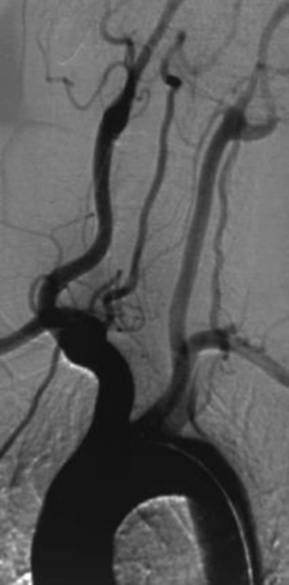 <p>What <span style="text-decoration:underline">invasive studies</span> should we do in <strong>vertebral-basilar insufficiency</strong>?</p>