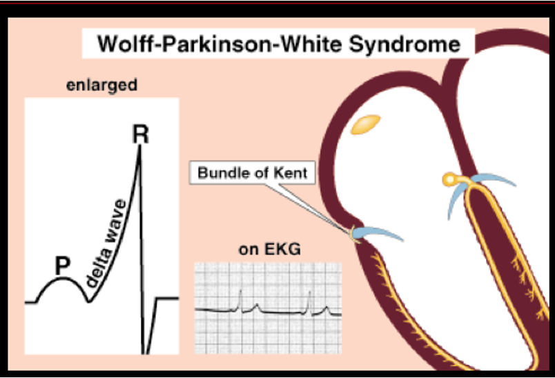 <p>short PR interval</p><p>wide QRS</p><p>delta wave</p>
