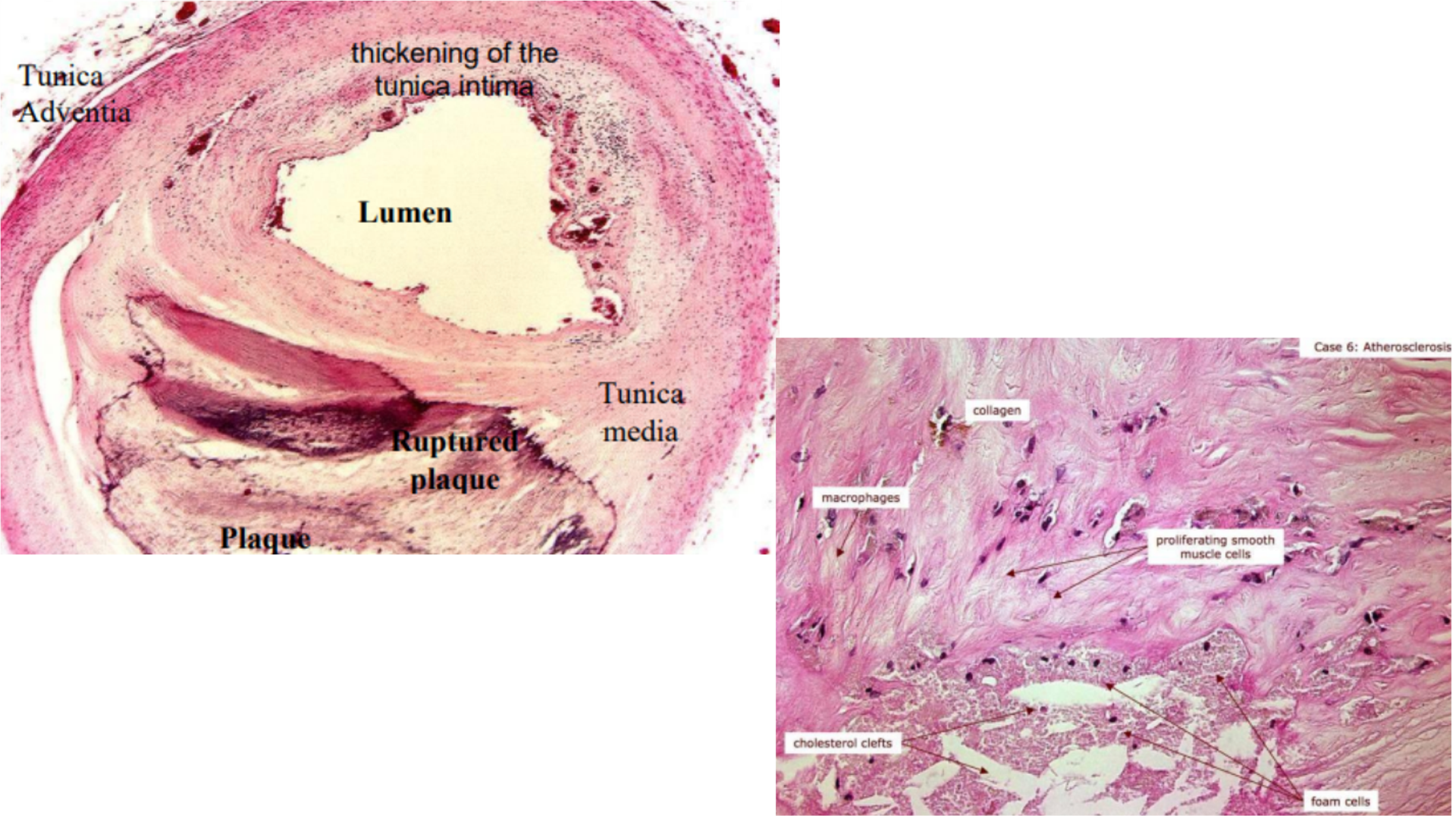 <p>Artherosclerosis</p>