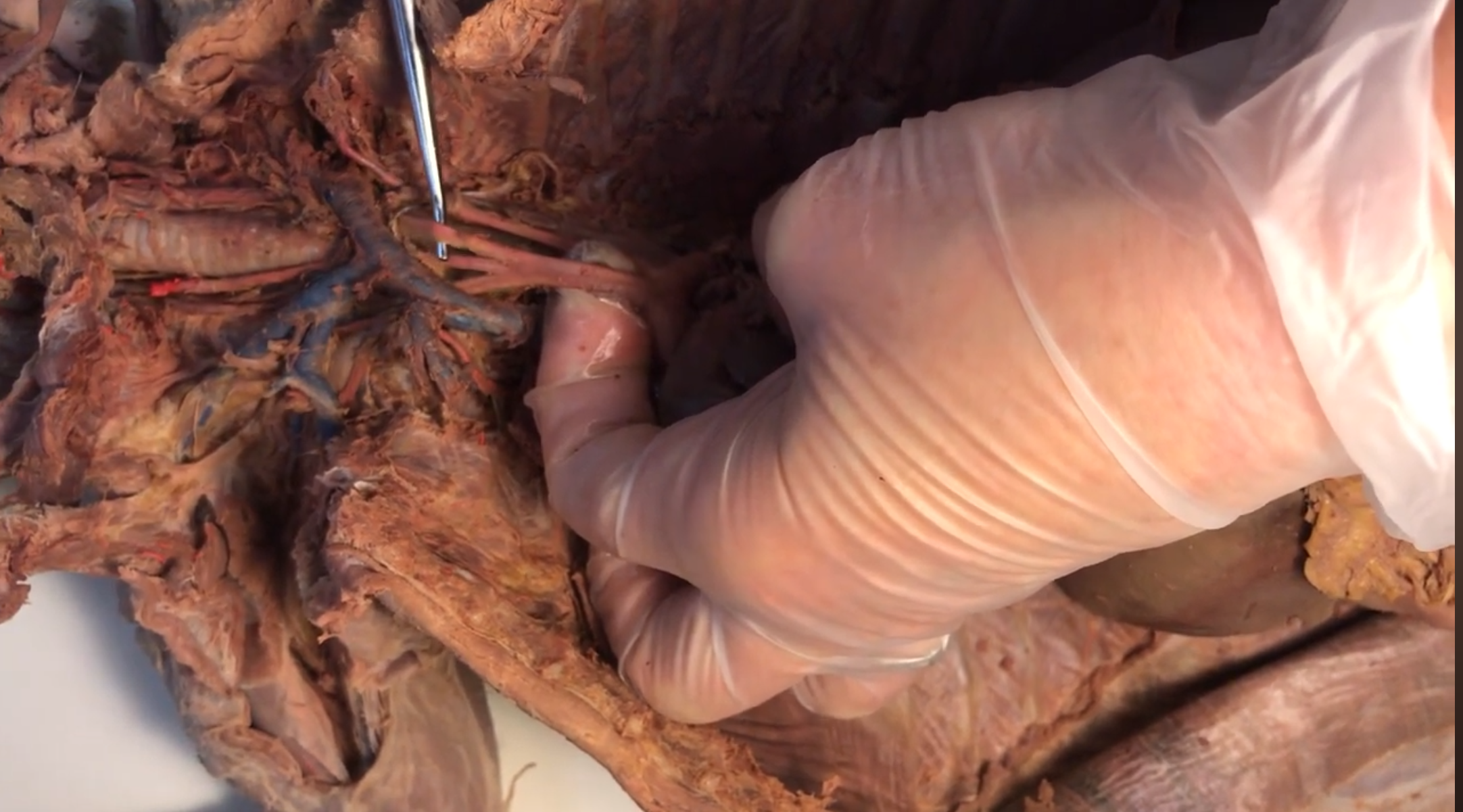 <p>What artery is this</p>