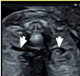 <p>the normal spine has 3 ossification centers called</p><p>a) right + left neural processes and the centrum</p><p>b) medial + lateral neural processes and the centrum</p><p>c) anterior + posterior processes and the magnum </p><p>d) anterior + posterior neural processes and the centrum </p>