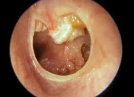 <p>Cholesteatoma of middle ear</p><p>M/P:</p><p>Cyst filled with abundant keratin + cholesterol clefts + large number of histiocytes.</p>