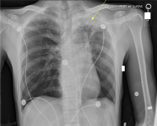 <p>What pathology is seen on this x-ray?</p>