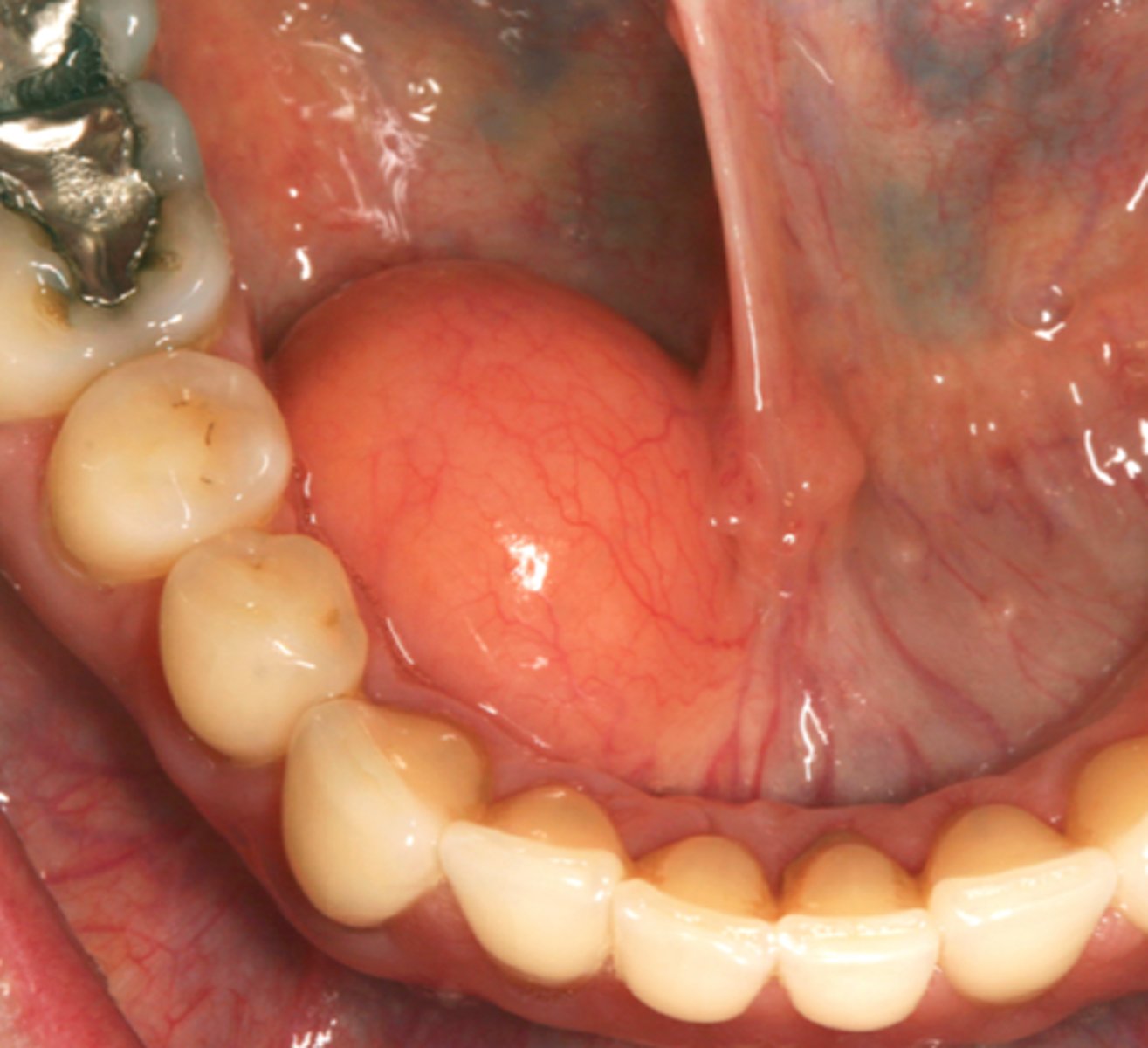 <p>soft, yellowish-pink, well-defined, painless nodule</p><p>• less than 3 cm</p><p>• common location: buccal mucosa</p><p>• population: adults over 40</p>