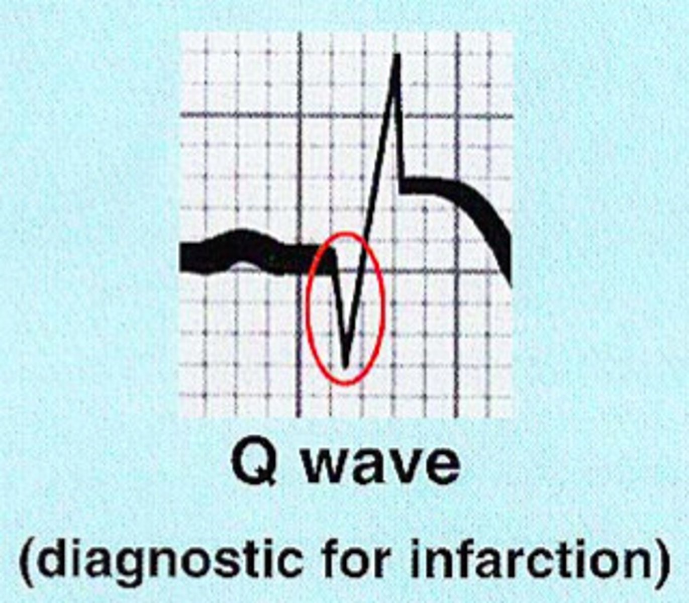 <p>significant Q waves</p><p>(≥than 1 square wide or ≥1/3 amplitude)</p><p>- indicated by Q-waves which make the dx</p><p>- Infarction is completed, now dead tissue</p><p>(canNOT be reversed, permanent damage)</p>