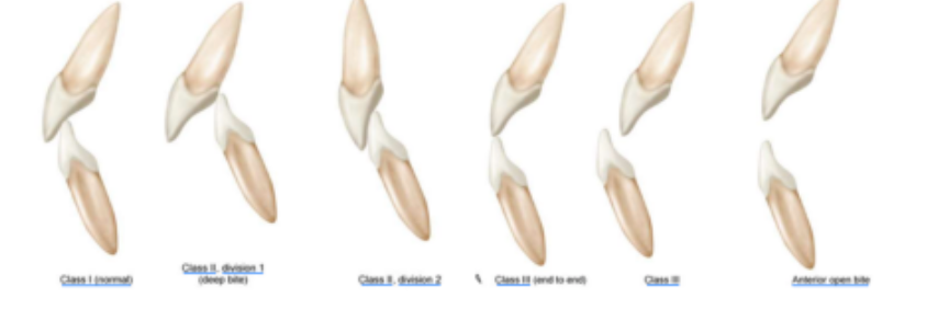 <p>class III end to end </p>
