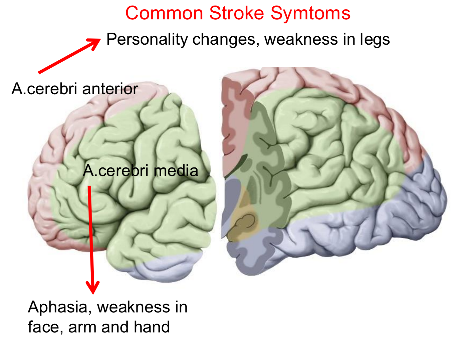 <ol><li><p>Aphasia </p><ul><li><p>L<span><span>anguage disorder that </span></span>affects your ability to speak and understand what others say</p></li></ul></li><li><p>Weakness in face, arm, and hand</p></li></ol><p></p>