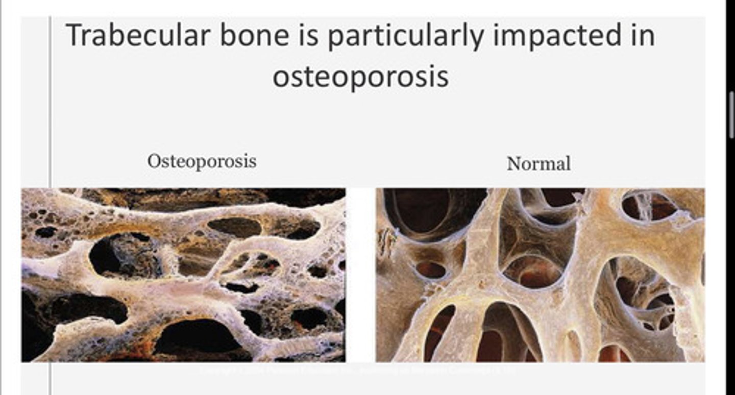 <p>The loss of cancellous (spongy) bone associated with reduced mechanical strength and increased susceptibility to fractures (common in wrists, hips and spine).</p>