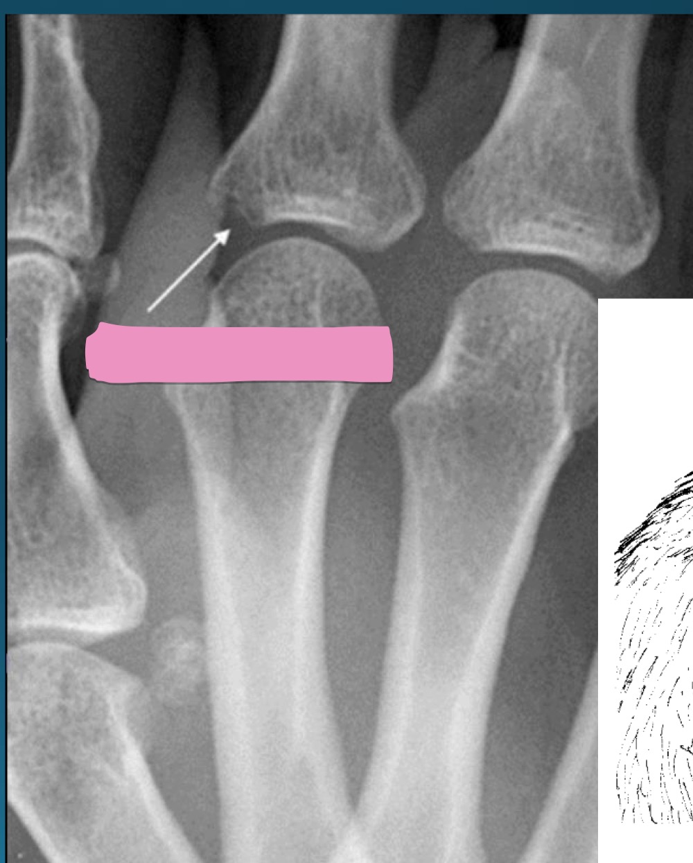 <p>what do they call this feature? </p><p>part of what diagnosis>?</p>